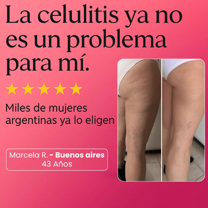 Tratamiento de celulitis  Sculptique™