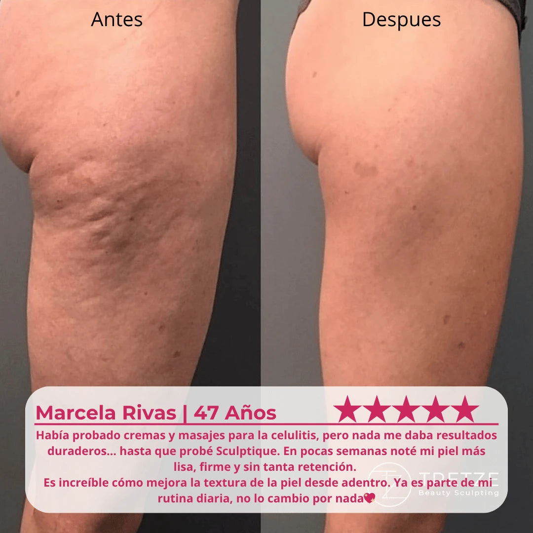 Tratamiento de celulitis  Sculptique™